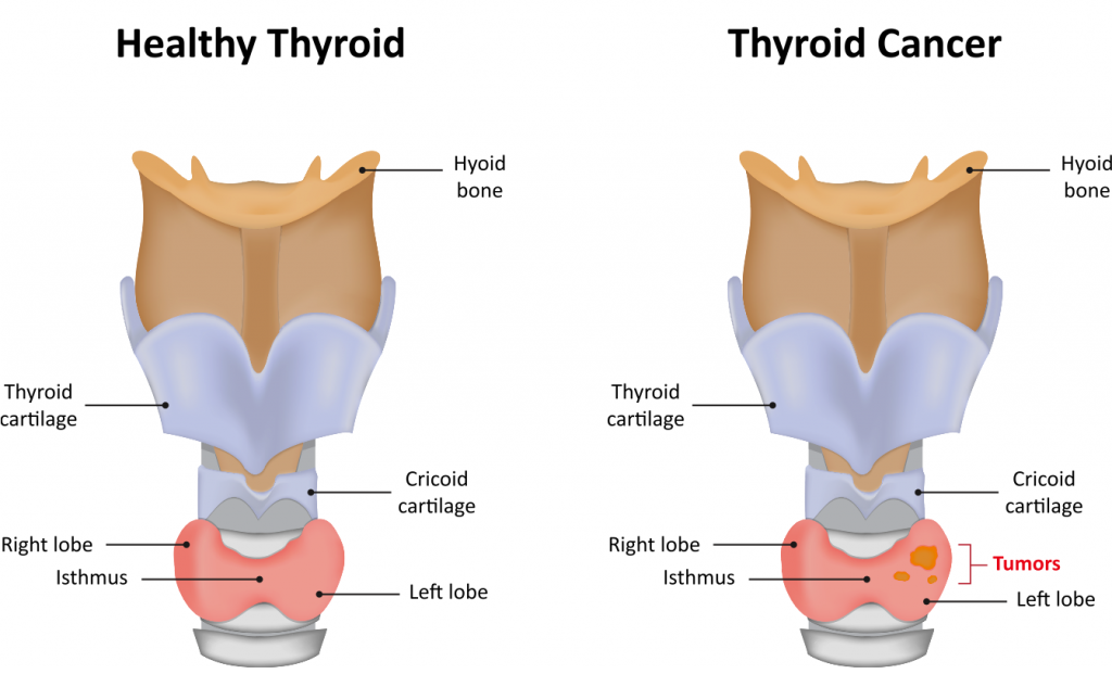 thyroid tumor
