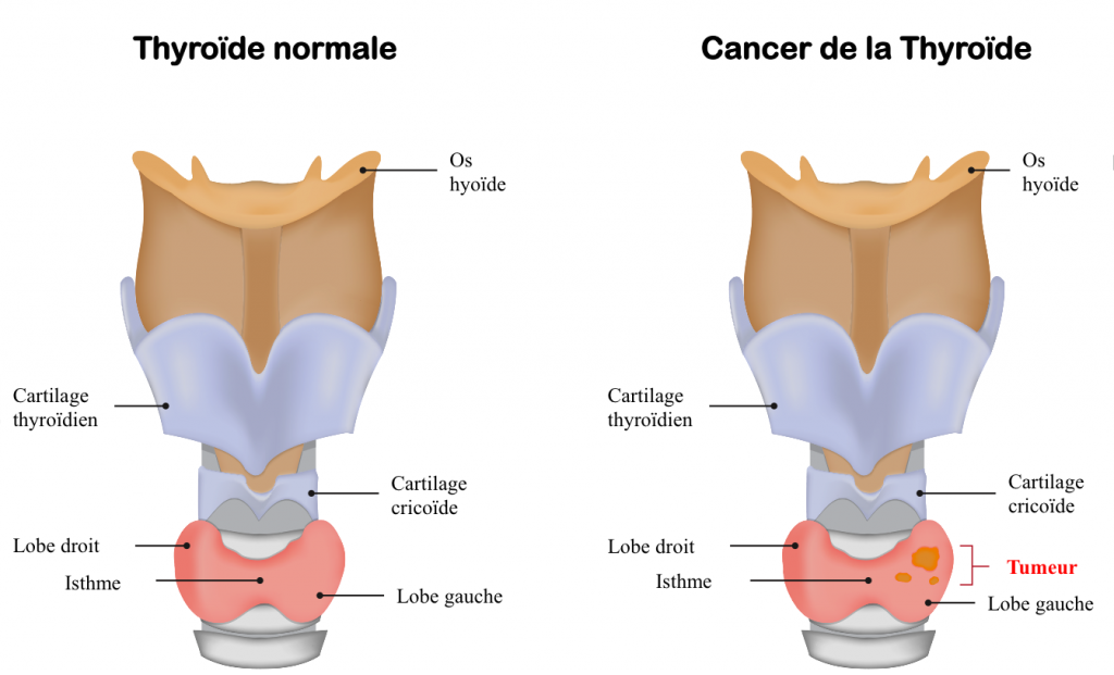 tumeur-thyroide