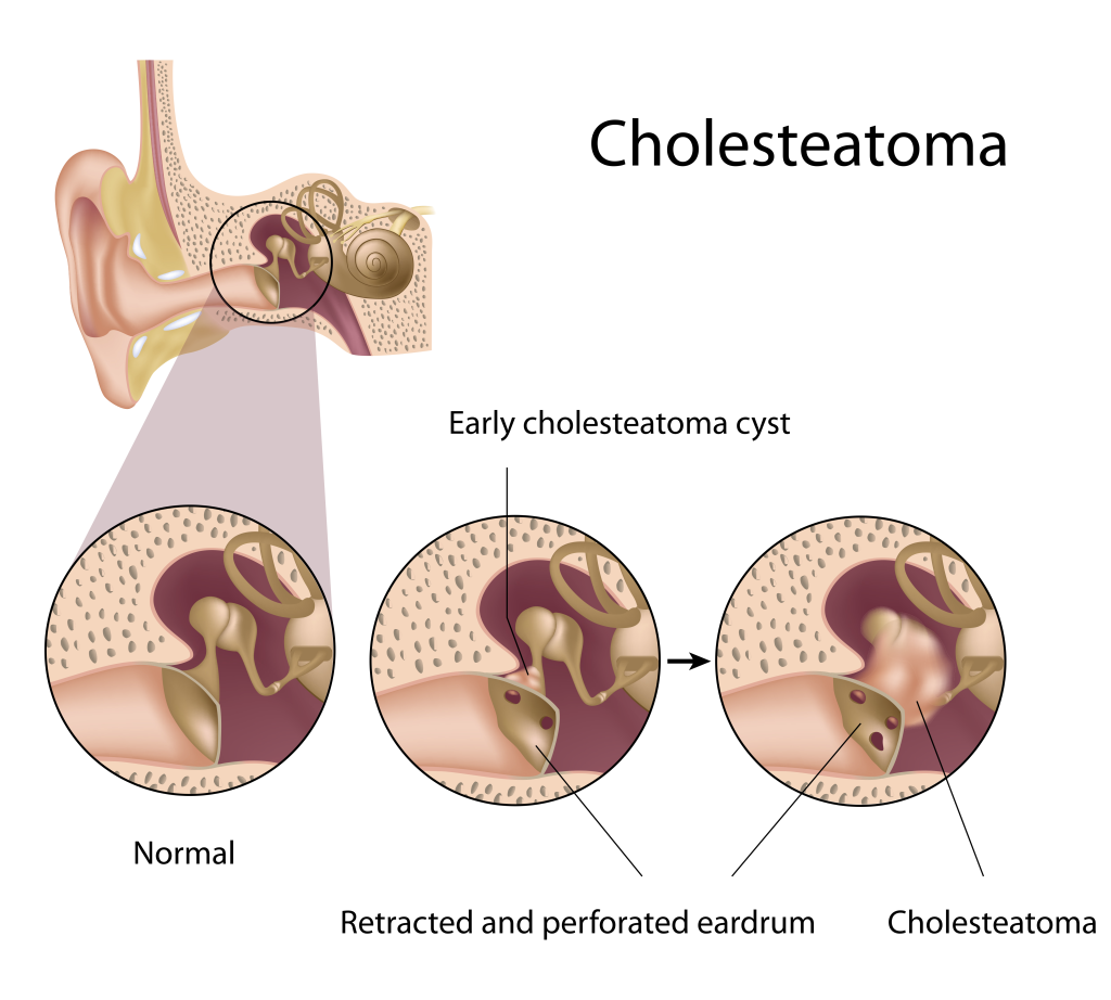 Cholesteatoma_127210973