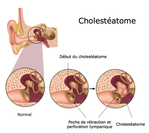 Cholestéatome-oreille