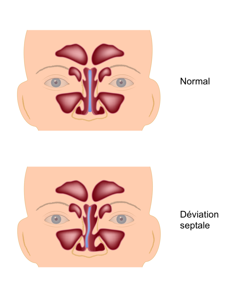 Déviation de la cloison nasale | Polyclinique Centre-Ville