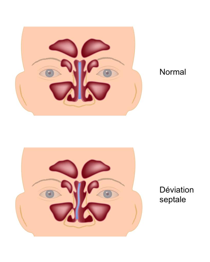 deviation septale